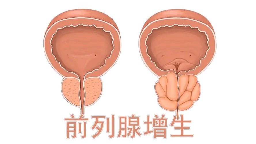 男人40歲之後如果不想被前列腺增生盯上這7件習慣要堅持