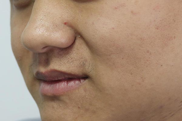 什么是蜘蛛痣 手上有几个蜘蛛痣-朝阳百科