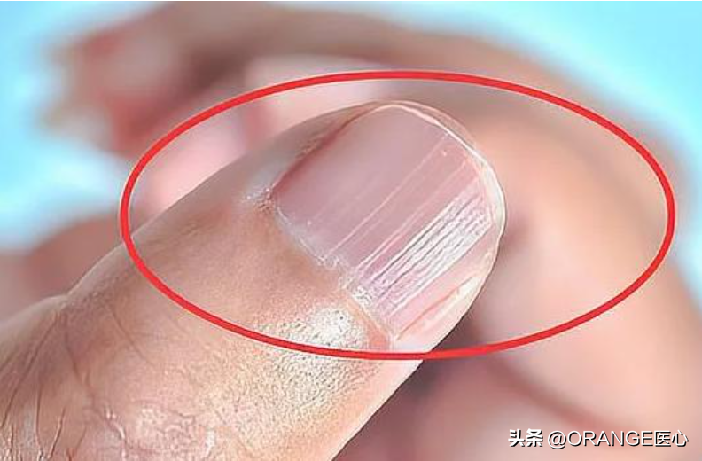 手指甲有竖纹是怎么回事（手指甲有竖纹代表着什么？可能是身体求救的信号）