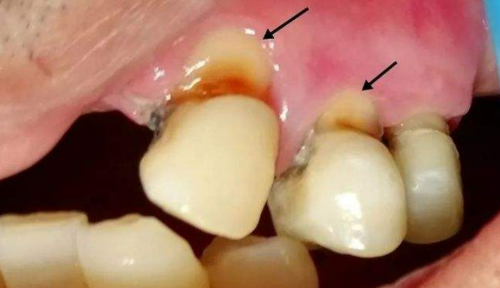 如果你牙齿外面的牙釉质被口腔酸环境侵蚀和破坏,导致牙本质暴露,再加