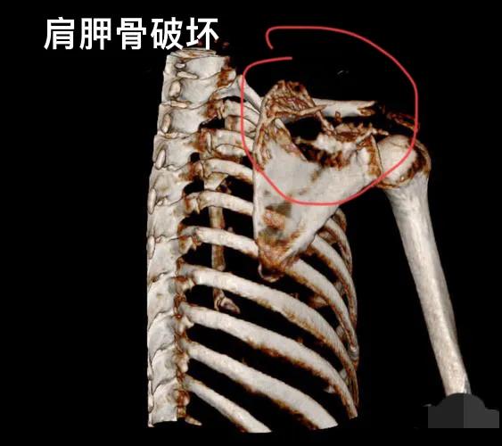 右侧肩胛骨痛3个月，可能是哪种病？
