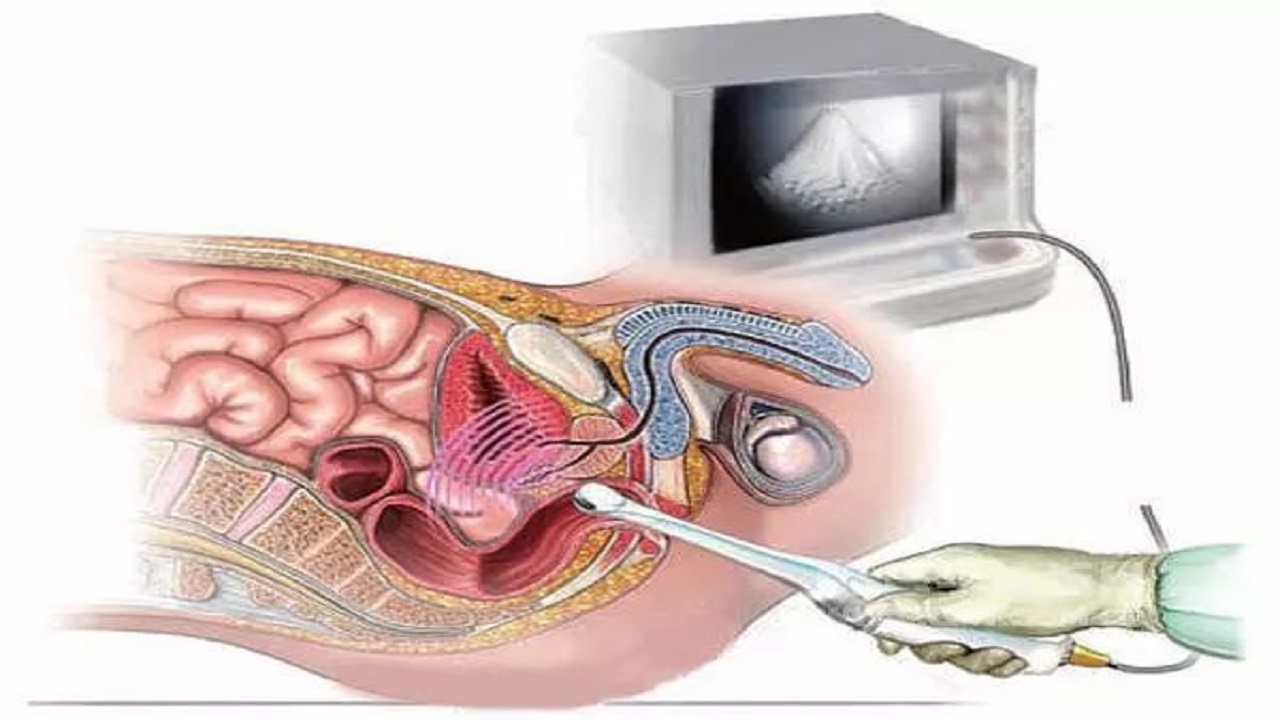 前列腺彩超可以检查前列腺的大小,是否有结节,判断前列腺的边界,但不