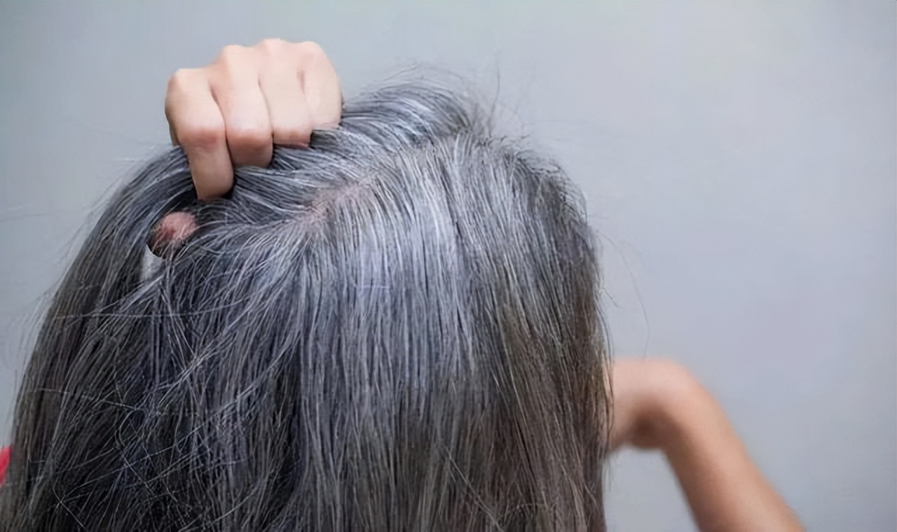 女性"白发"日渐增多,不要认为自己老了,可能是缺乏这3种营养