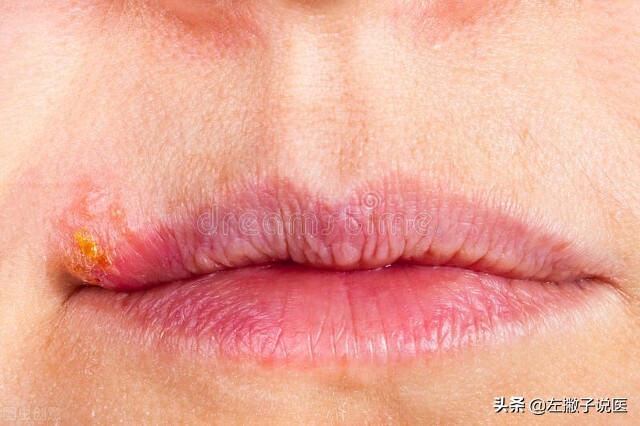 76口唇疱疹这是单纯疱疹病毒1型感染引起的,可在患者的嘴角或者嘴唇