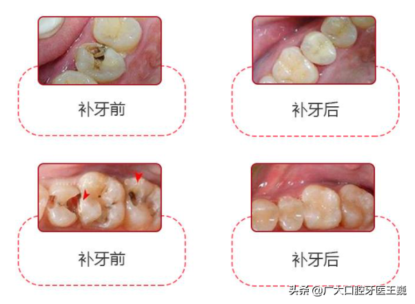 牙齿色素沉淀怎么去除图片