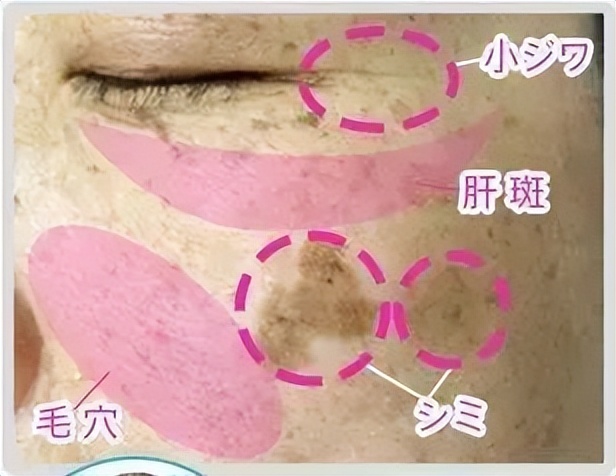 怎么樣能祛斑（別踩雷啦，真正有效的祛斑方法都在這了）
