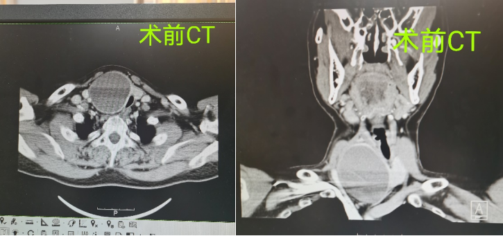 广西甲状腺结节去哪里治疗(甲状腺囊实性结节治疗新选择——微波消融助力实现“去病无痕”)