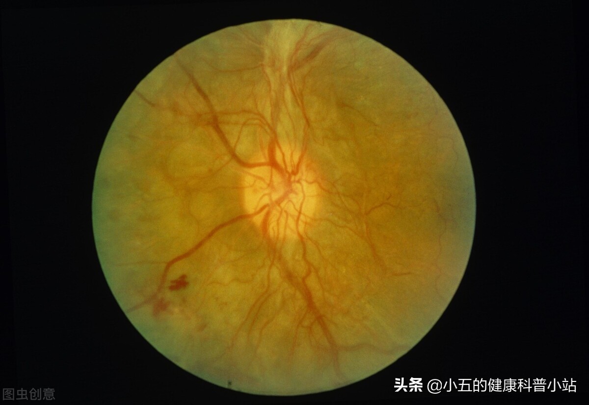 长期糖尿病引起血管损伤怎么办？合理使用4种药物，帮你保护血管