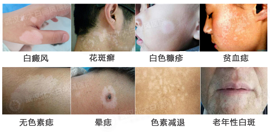 孩子身上出现白斑,怎么判断是不是白癜风?