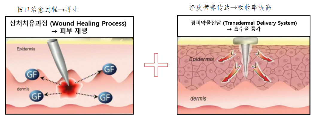 美克拉系统：皱纹为什么那么难去除，皮肤管理中心是如何除皱的