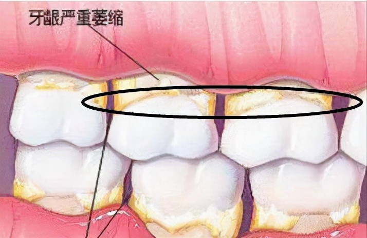 人到中年牙齿松动、不牢固？医生：这些方法挽留牙齿很实用