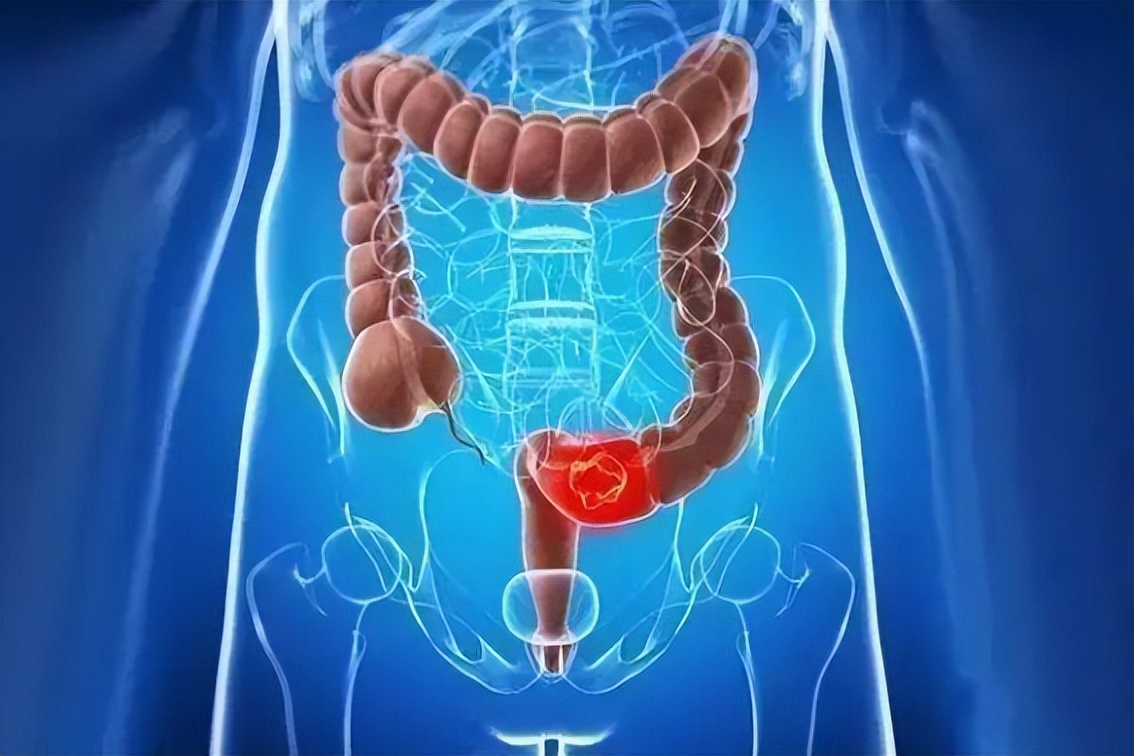 肠癌最明显的症状 肠癌放屁特点-大连号