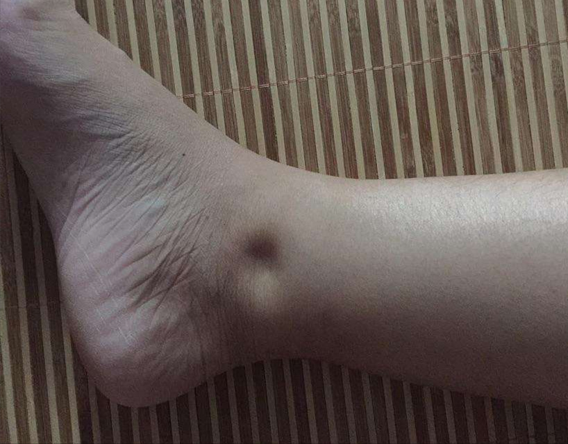 为什么会有水肿？如何吃才能消水肿？喝红豆水有效吗，这类人避免