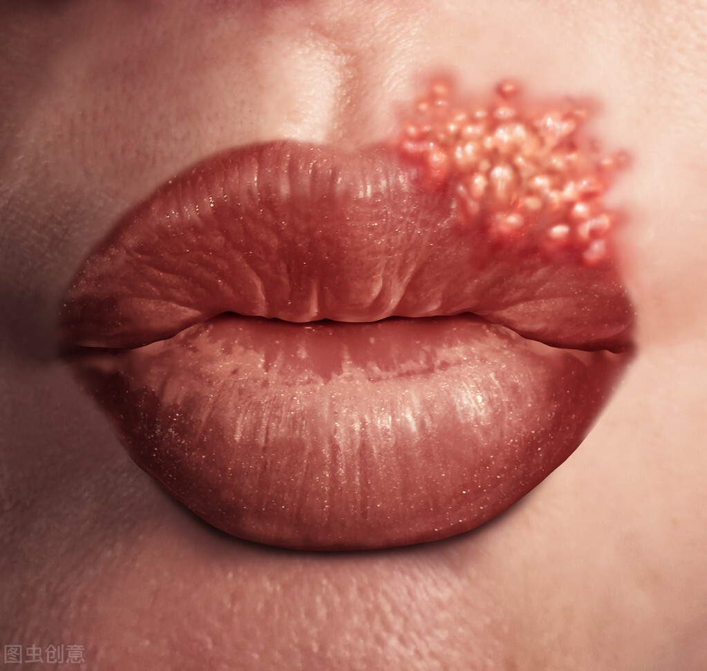 水泡和疱疹的区别图片 嘴角水泡和疱疹的区别图片-人人投票