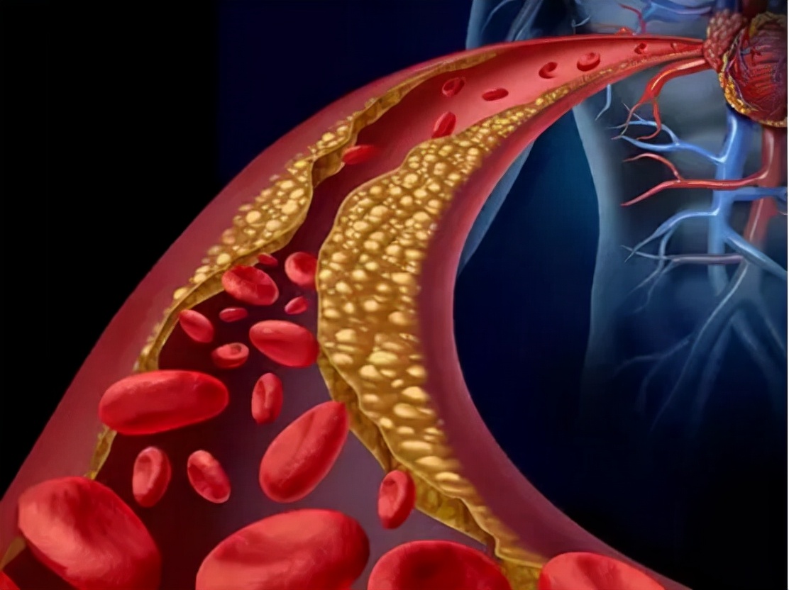 高血脂颈动脉斑块，吃鱼油1年，血管软化了吗？如何预防高血脂？