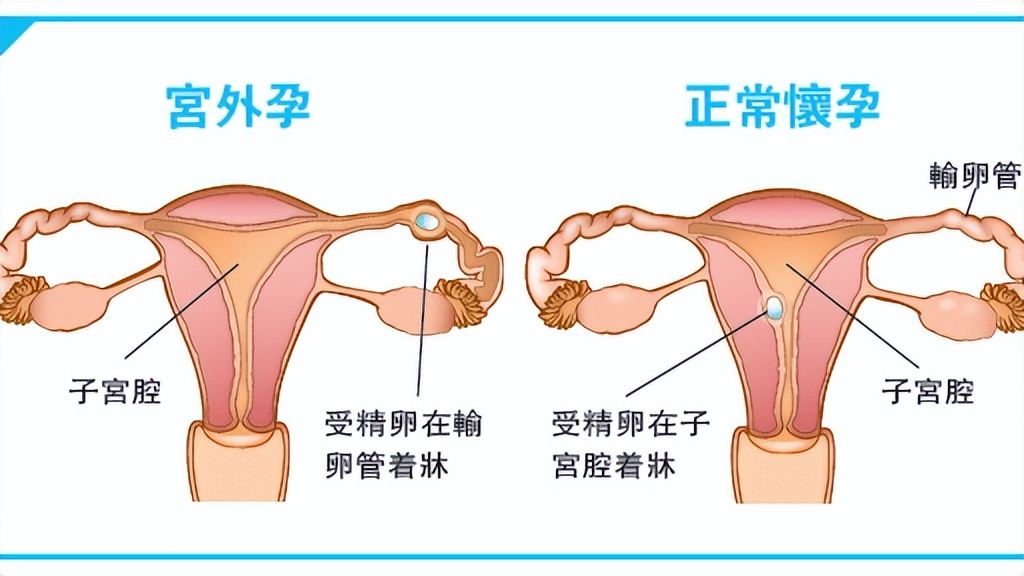 什么是宫外孕(宫外孕是怎么一回事) - 百百科