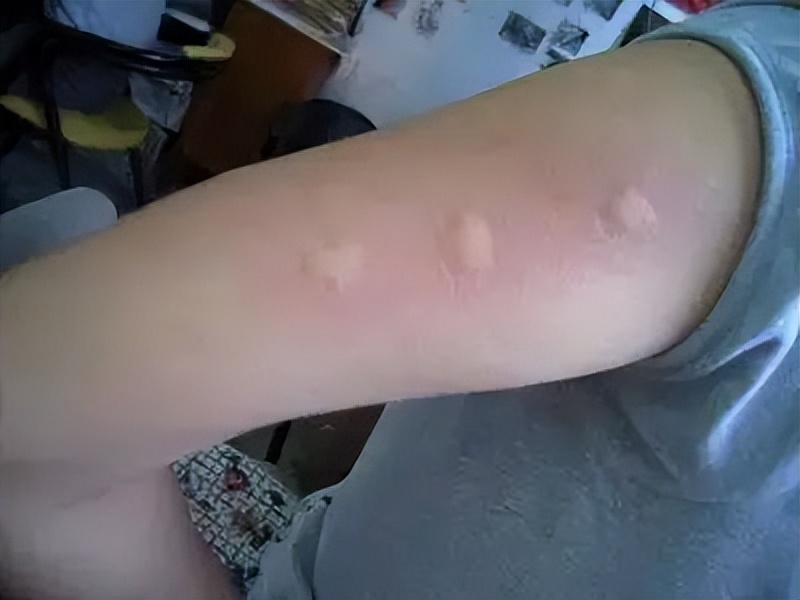 樟脑成分)就算是宝宝也可以使用,但要注意如果蚊子块被抓破了或破皮了