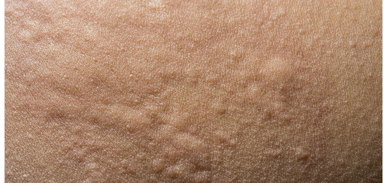 大便不成形,排便细粘便池,容易得脚气,容易得湿疹,荨麻疹等皮肤病