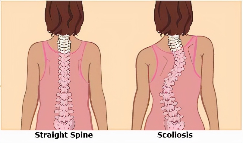 驼背手术多少钱(治疗脊柱侧弯花费近13万) 
