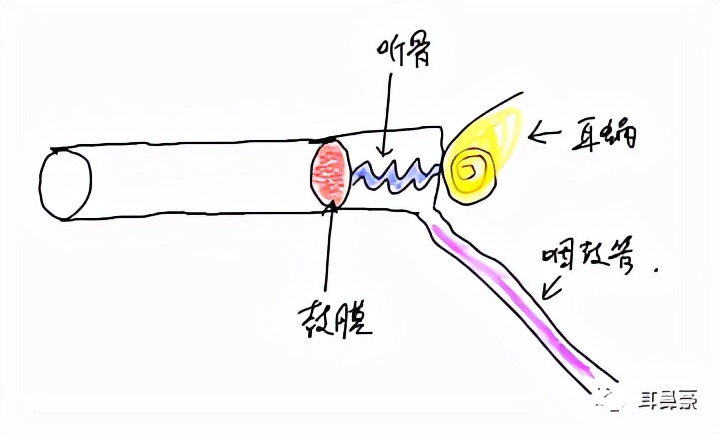 【爱耳日系列科普之中耳炎】中耳炎手术