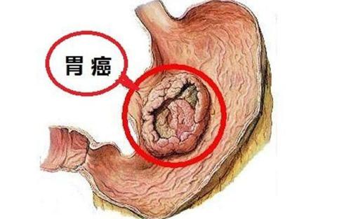 美国把幽门螺旋杆菌列为致癌物,我国感染率达59％!医生教您杀灭它