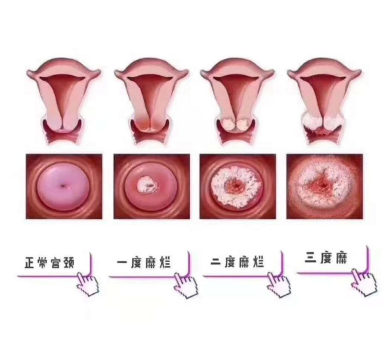 宫颈筛查正常图片