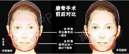 颅顶增高、小腿肌肉阻断、断骨增高，“酷刑”医美缘何前赴后继？