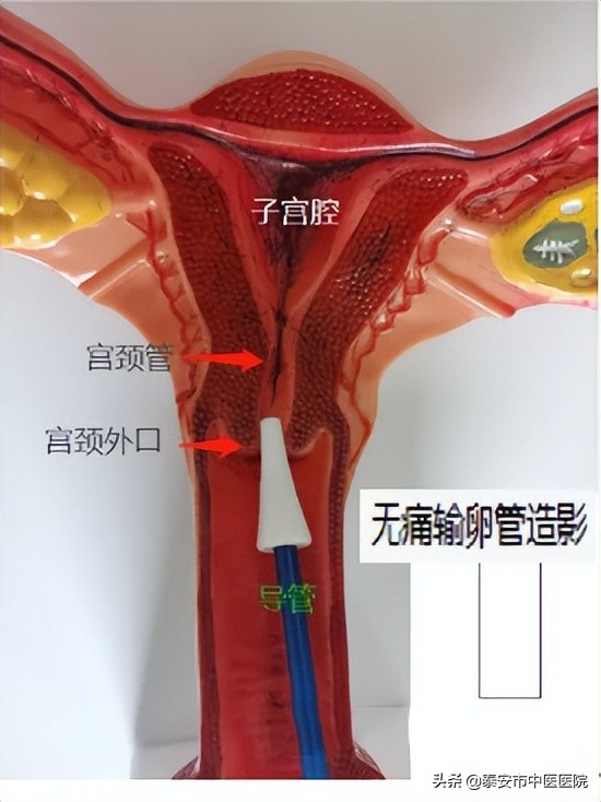 技术创新无痛输卵管造影技术跟疼痛不适说拜拜