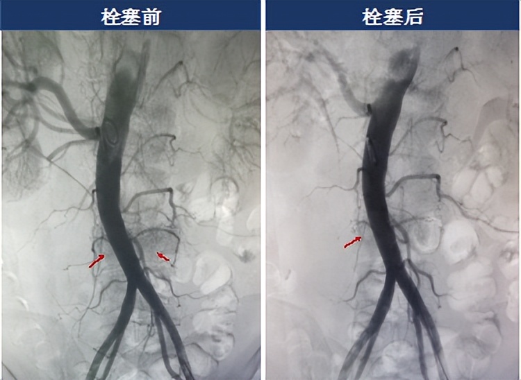 55岁腰椎体转移瘤患者急需手术 肿瘤供血动脉栓塞术保驾护航