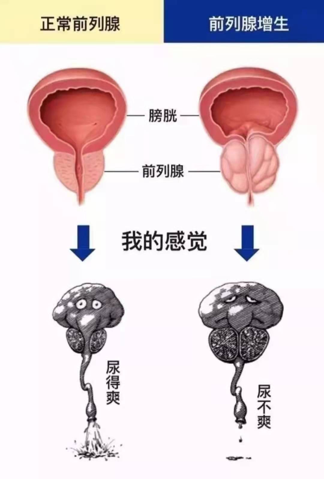 前列腺增生治疗(前列腺增生的“苦”，懂得都懂！3种一线治疗药物，医生一文说清)