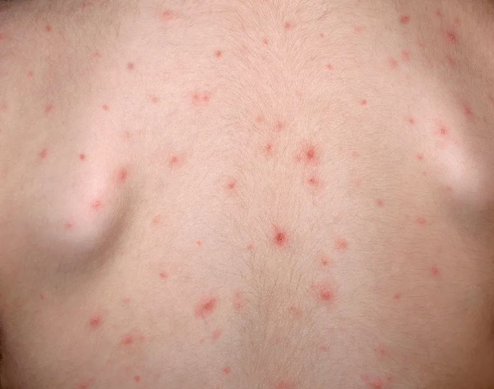 chickenpox)是由水痘