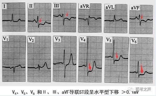 两种中成药，多靶点“清理血液”，从根上疏通冠脉，改善心肌缺血