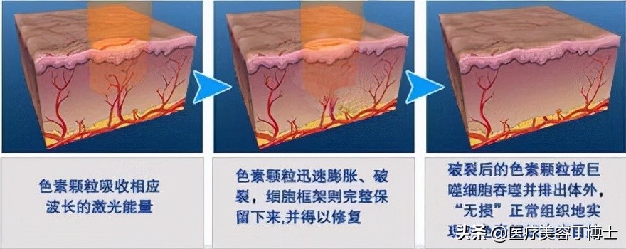 太田痣是怎么形成的，有没有有效的治疗方法