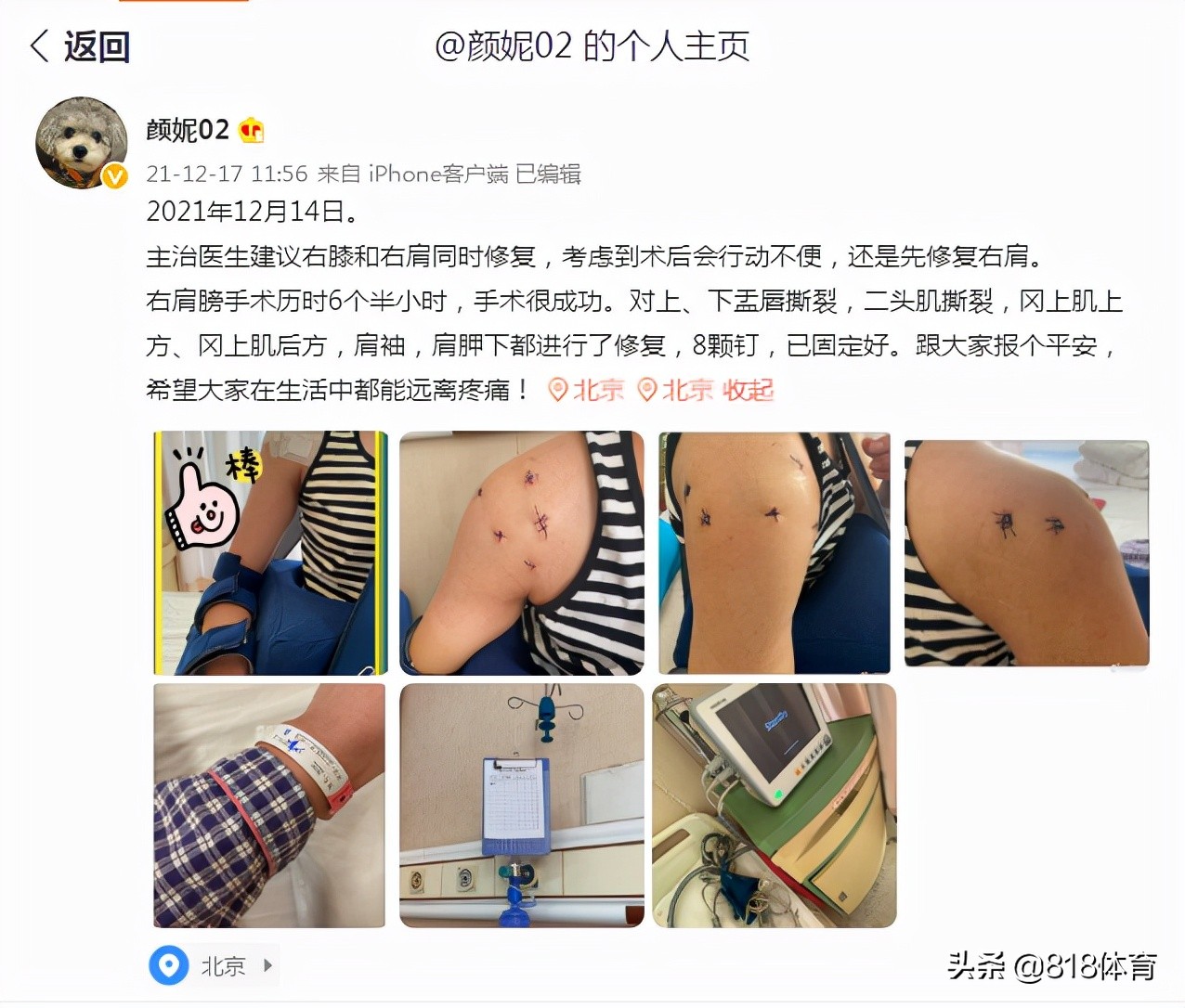 泪目!女排北长城颜妮6个半小时手术报平安,修复右肩成功打8颗钢钉