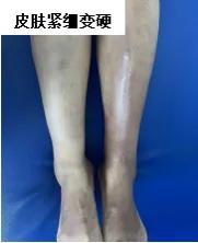 关节肿痛、皮疹… 这些可能是硬皮病 专题义诊活动等你来