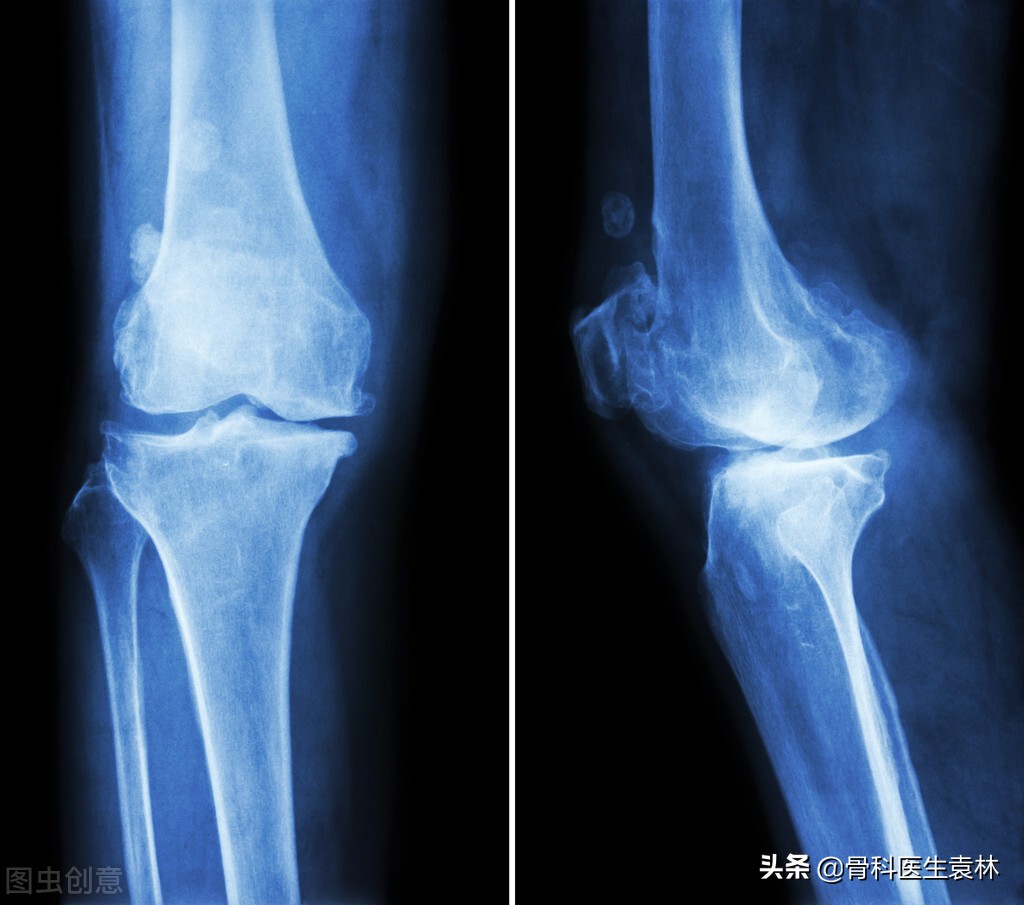 膝盖骨刺最有效的办法解析，膝关节长骨刺怎么治疗？