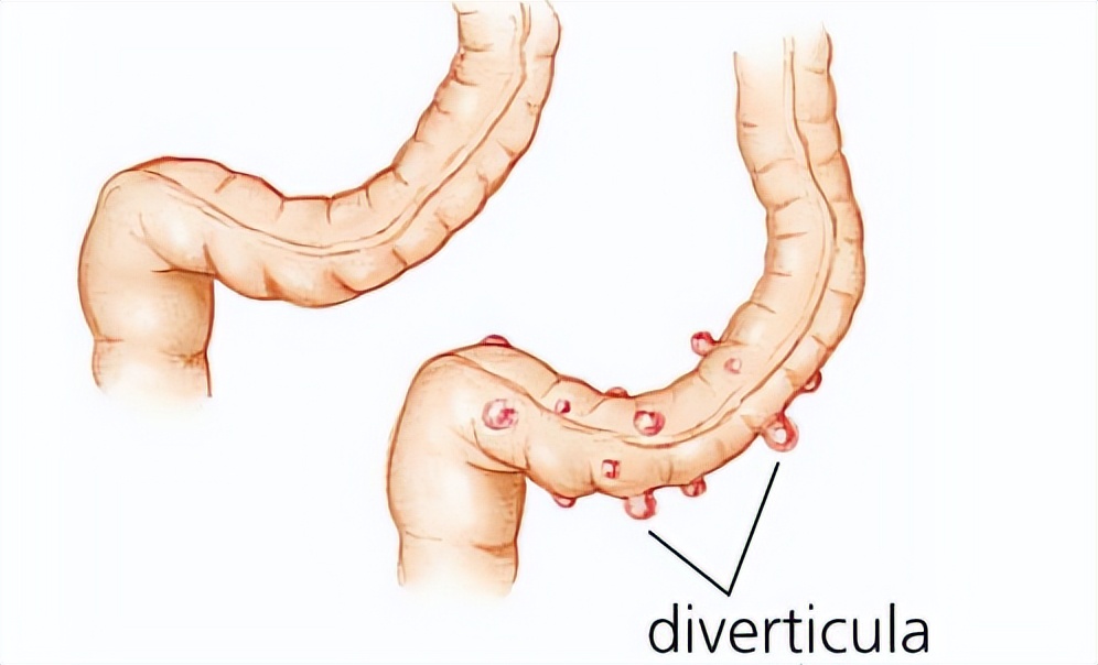 突发腹痛拉肚子竟是大肠憩室炎？如何和阑尾炎区分？如何预防？