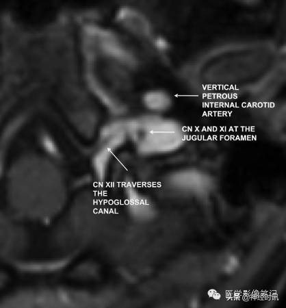12对脑神经记忆口诀及图谱，别说你没见过