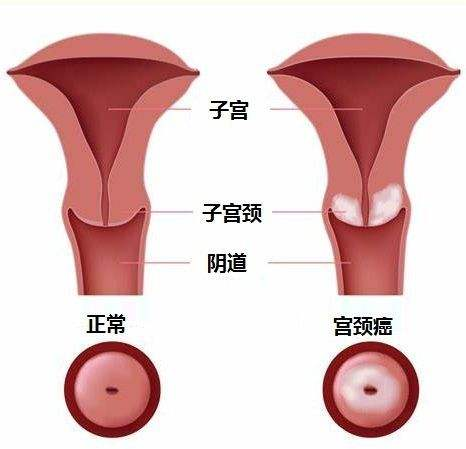 丁丁冒出白色液体,不会是淋病吧?