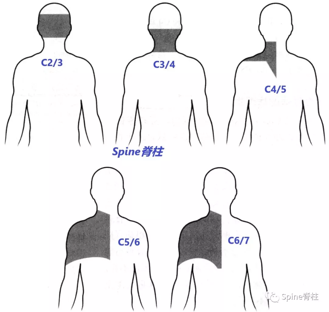 颈椎病：定义、分型、临床表现、治疗和预防