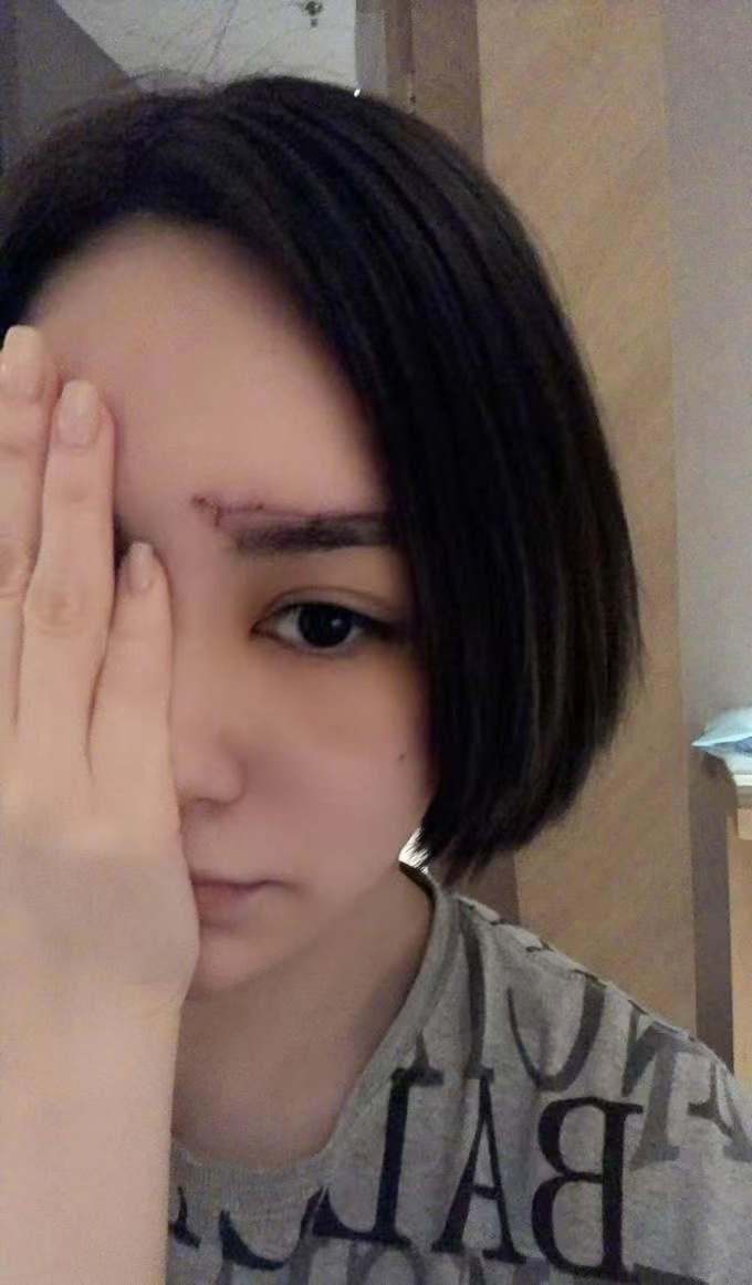 杨幂的眼角，阿娇的脸，明星脸上受伤、毁容，各个让人揪心