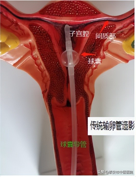 传统的子宫输卵管造影是在宫腔内插管来完成实现的,如下图:传统的子宫