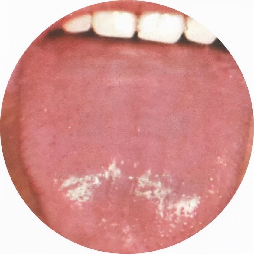 正常舌头图片(舌苔你会看吗) - 赤虎壹号