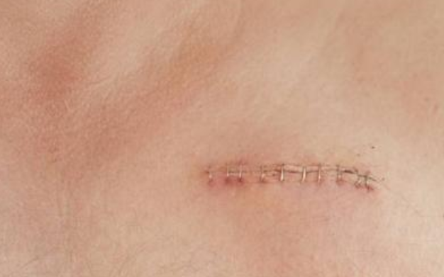 什么是疤痕体质（疤痕体质想要做近视激光手术？一定要弄清楚这几点，再做决定）