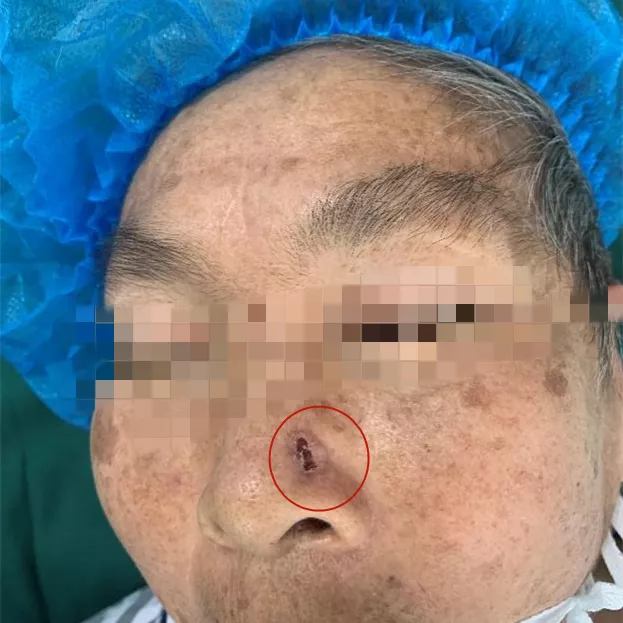 鼻头一粒小疙瘩,几年长成黑色“乒乓球”,一查竟是癌