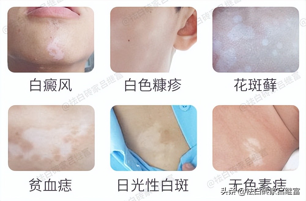 但是色素减退也包括很多疾病,如无色素痣,贫血痣,白色糠疹,白癜风等