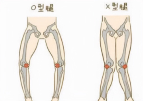 不死的癌癥：冬季高發(fā)的骨關(guān)節(jié)疾病