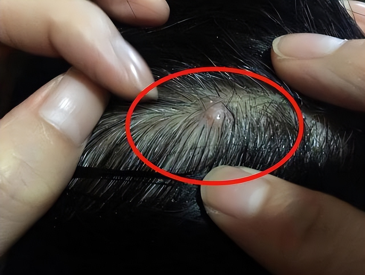 头皮上经常长脓包和疙瘩,是咋回事?提醒:这3种病或要考虑在内