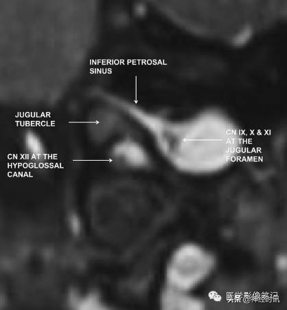 12对脑神经记忆口诀及图谱，别说你没见过