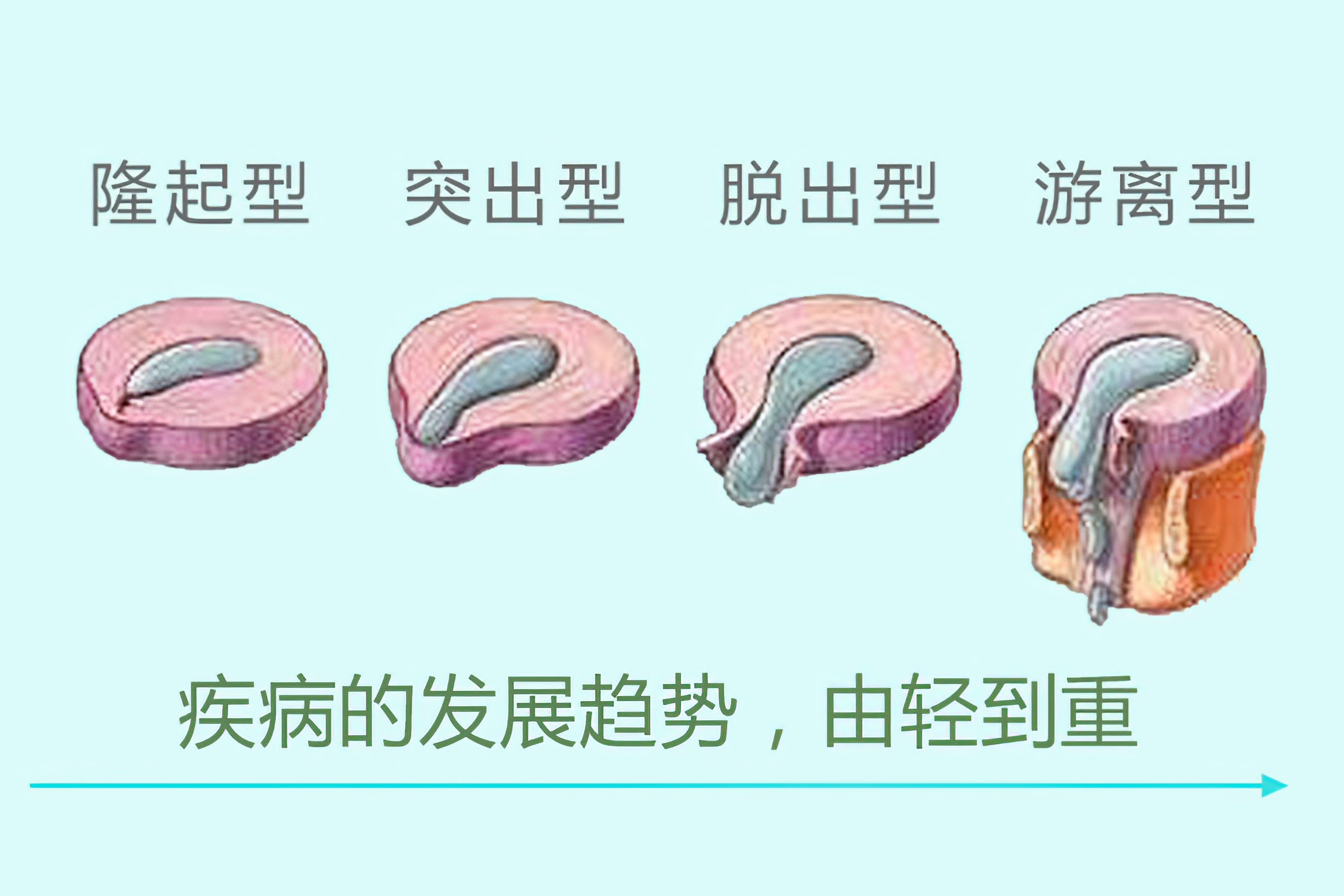 腰椎間盤突出症不同的時期,治療的重點不一樣!